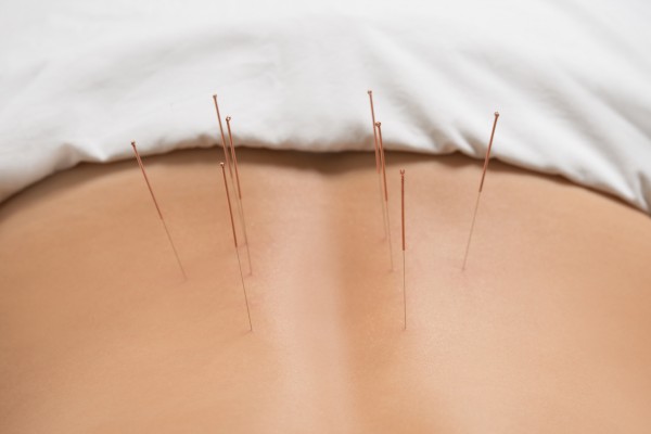 Akupunktur LWS